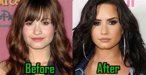 Demi Lovato Plastic Surgery Nose Job Chin Surgery Before After