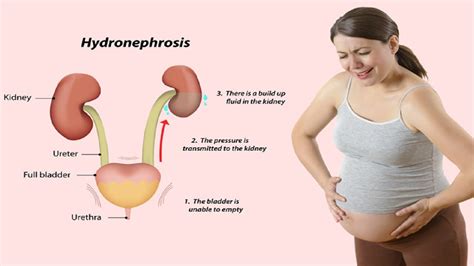 Urinary Tract Infection Uti In Pregnancy Symptoms Treatment
