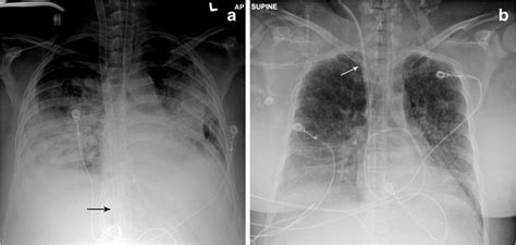Malpositioned Cannulas Chest Radiograph Of A 54 Year Old Male Status