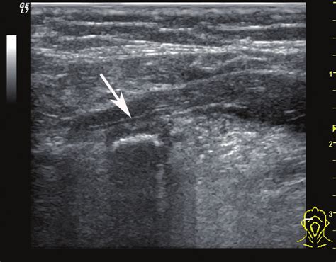 Ultrasonogram Of The Right Submandibular Gland Salivary Stone 7 Mm