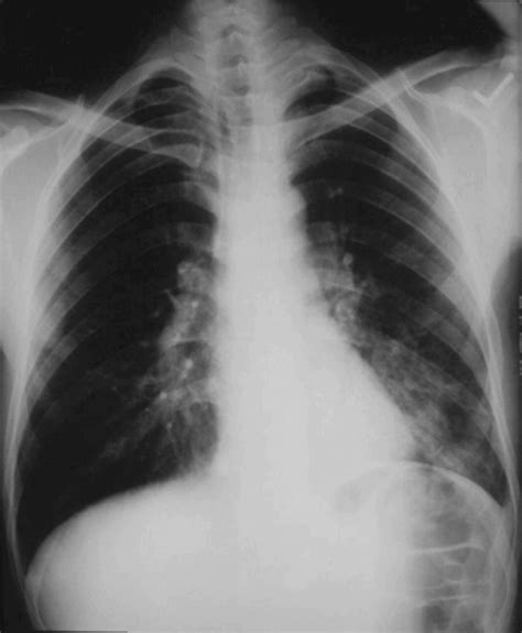 Pneumonia is a common lung infection caused by bacteria or viruses that can lead to mild to severe illness. Pneumonia: Macrolides or amoxicillin for community acquired pneumonia? | The BMJ