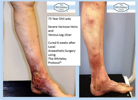 Varicose Veins And Venous Leg Ulcer Cured In 6 Weeks