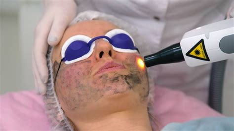 Carbon Face Peeling Procedure Laser Pulses Clean Free Stock Photo And