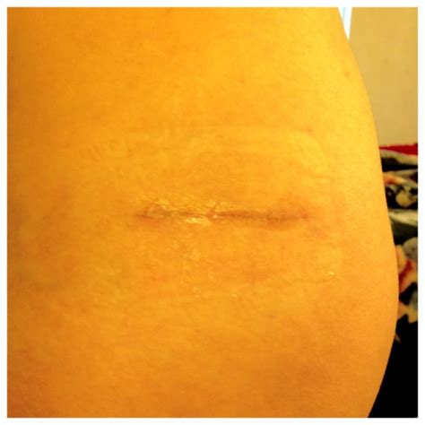 Example Of Well Healed Incision At 1 Month Gravity Medical Spa