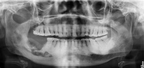 Osteomyelitis Jaw Radiographic Appearance