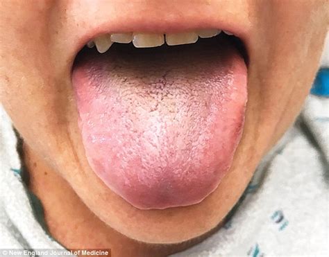 Womans Tongue Turned Black And Hairy Because Of An Antibiotic