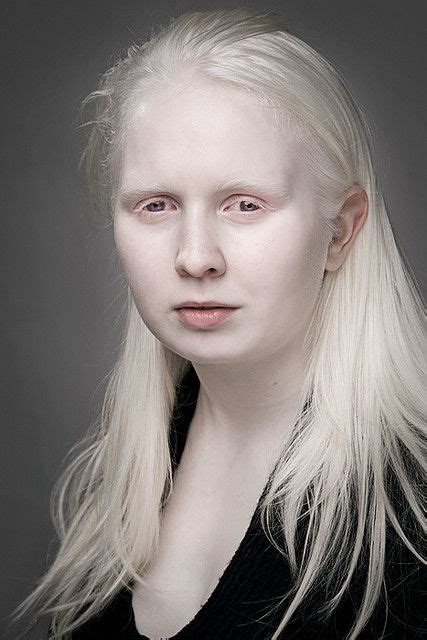 Cecilie Albino Human Albino Girl Albino