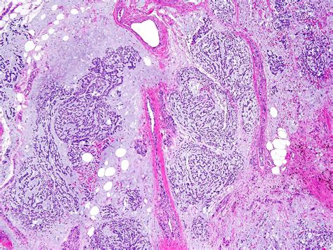 Extraskeletal Myxoid Chondrosarcoma Pathology Outlines Pathology