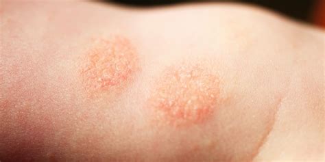 Você Sabe O Que é Dermatite Especialista Esclarece Sintomas E Tratamento