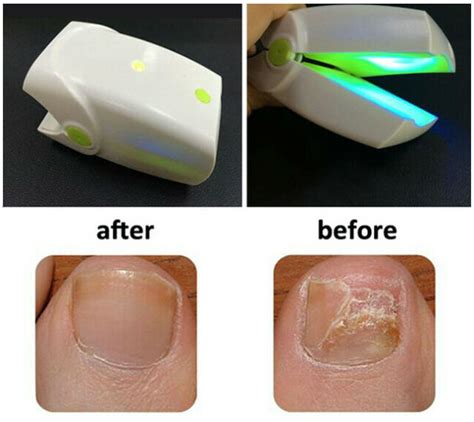 Nail Fungus Laser Therapy Device Toe Finger Onychomycosis Infection