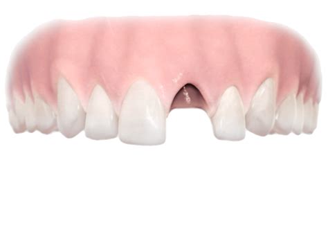 Yhden hampaan korvaaminen | Dentsply Sirona