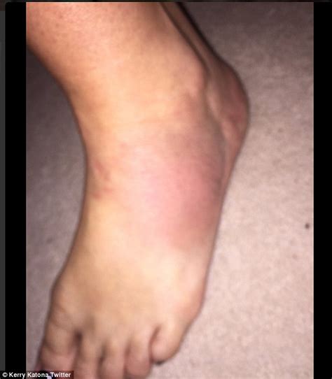 Kerry Katona Suffers A Christmas Calamity And May Have Broken Her Foot