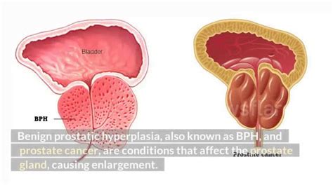 Enlarged Prostatebph Prostate Cancer Causes Risk Factors Signs And Symptoms Diagnosis