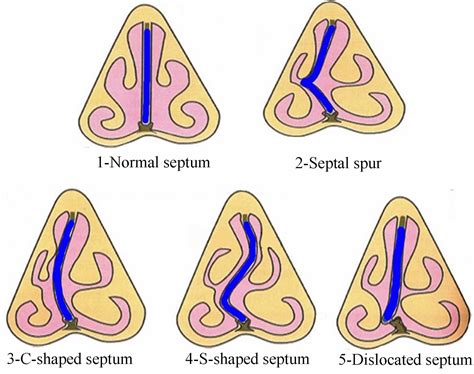 Types Of Nasal Septum Deformalities