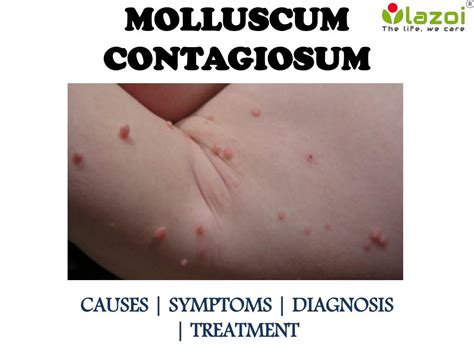 Ppt Molluscum Contagiosum Causes Symptoms And Treatment Powerpoint