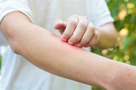 Premium Photo Man Itching And Scratching On Arm From Allergy Skin