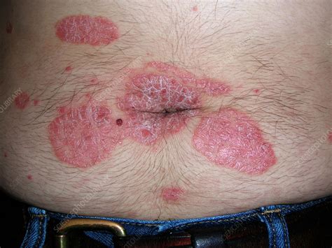 Psoriasis Stock Image C0565033 Science Photo Library