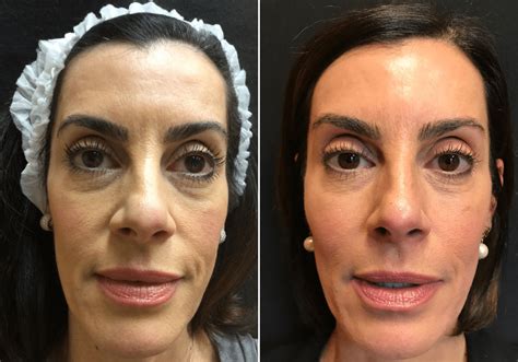 Nonsurgical Facelift With Botox Voluma And Sculptra