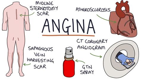 Understanding Angina Visual Explanation For Students Youtube