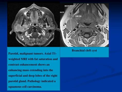 Ppt Branchial Cleft Cyst Powerpoint Presentation Id261469