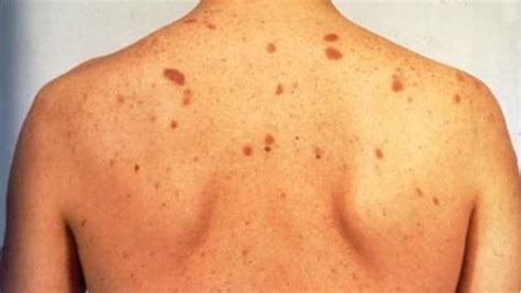 Common Skin Disorders Pictures Photos