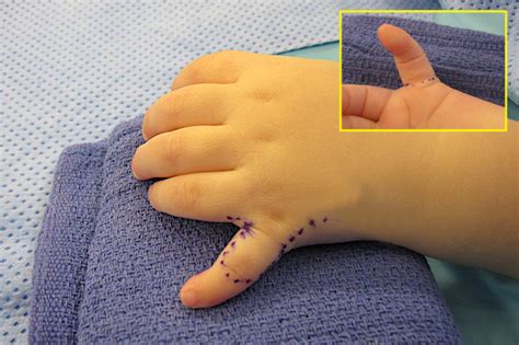 POLYDACTYLY Hand Surgery Source