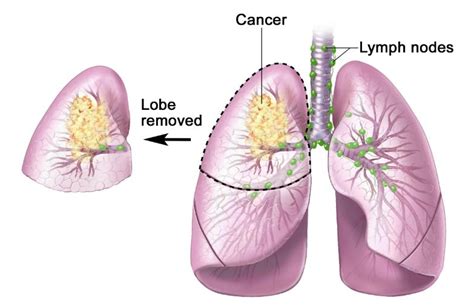 Stage 3 Lung Cancer Life Expectancy Cancerwalls