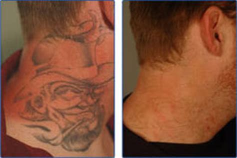 How much do tattoos cost? Tattoo Removal Costs