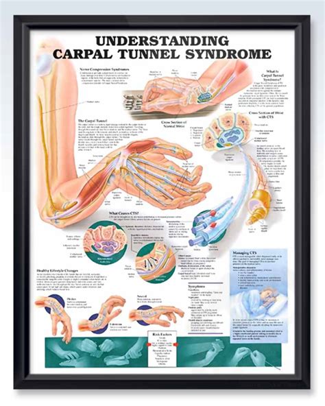 Carpal Tunnel Syndrome Exam Room Anatomy Poster Clinicalposters