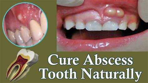 Tooth Abscess Home Treatment