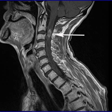 Sagittal T2 Weighted Mri Of His Cervical Spine Shows An Oblong