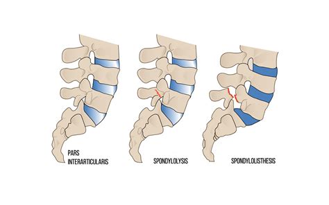 Spondylolysis And Hockey Athletes Remi Sovran