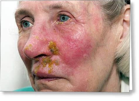 Shingles Rash On The Face Photograph By Dr P Marazziscience Photo Library