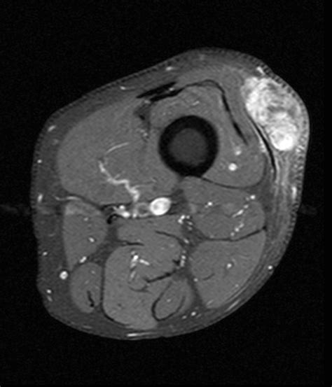 Myxoid Soft Tissue Neoplasms Radsource