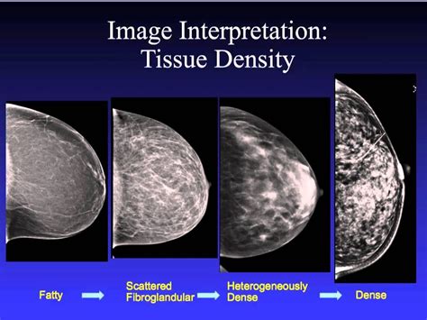 Introduction To Mammography Mammography Mammogram Medical Ultrasound