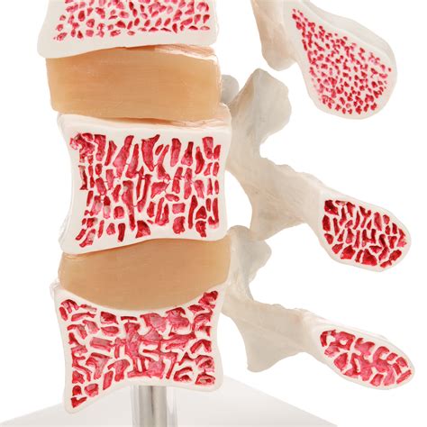 A Deluxe Osteoporosis Model Vertebrae B Scientific