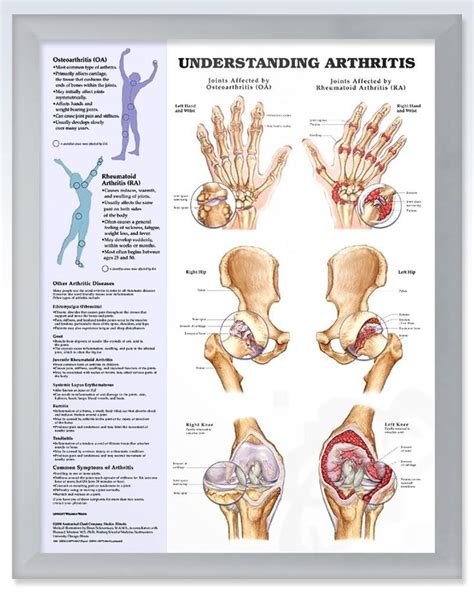 Understanding Rheumatoid Arthritis Chart X Arthritis Treatment My XXX