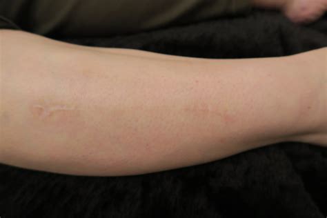 Scar Treatment Therapy By Christine Ringrose In Woodbridge Suffolk