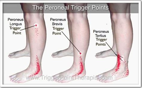 The Peroneal Trigger Points Ankle Pain Leg Pain Back Pain Peroneal