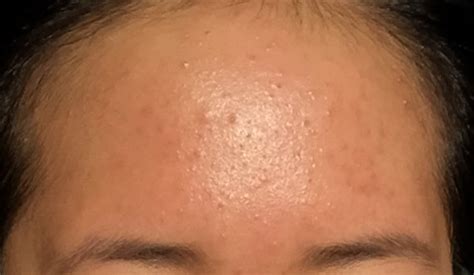 Oily T Zone Clogged Pores Or Pityrosporum Folliculitis Oily Skin