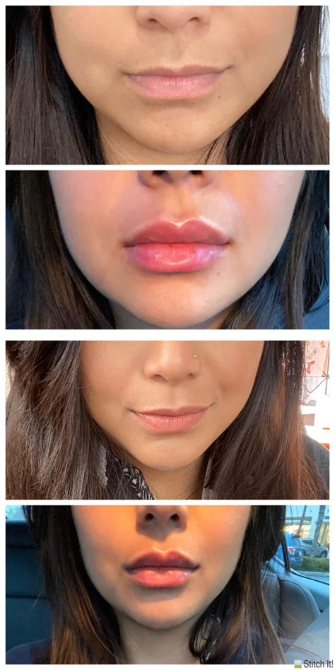 Got Lip Filler Today Pic Of Lips Before And Immediately After