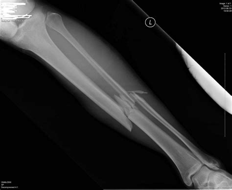 Worst Broken Arm X Ray