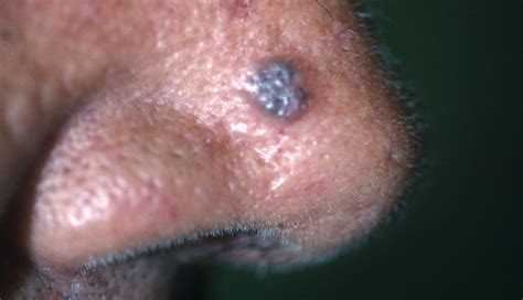 The Two Most Common Forms Of Skin Cancer Clinical Advisor