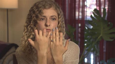 how woman with untreated strep throat is coping after losing fingers and toes youtube