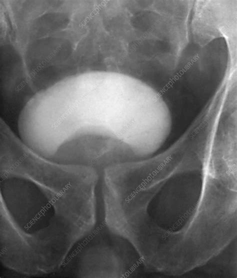 Prostate Disorder X Ray Urogram Stock Image C Science Photo Library