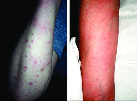 Early Stage Of Eruption Showing Erythematous Papules On The Patients
