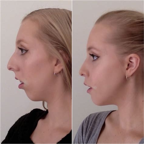 Double Jaw Surgery Journey