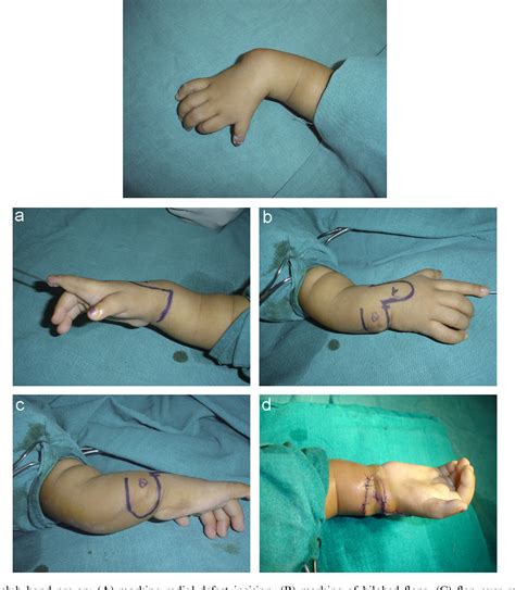 Figure From Treatment Of Radial Dysplasia By A Combination Of