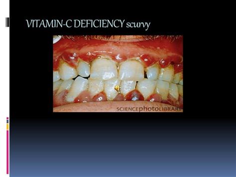 Vitamin C Deficiency Scurvy Ppt