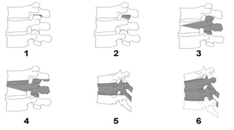 Pedicle Subtraction Osteotomy For Treatment Of Sagittal Plane Deformity